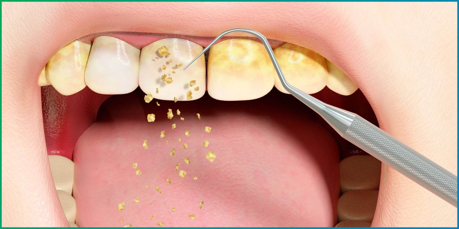 Tooth Cleaning Treatment Mumbai | Diagnopein Dental