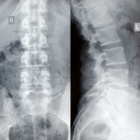 X-Ray Right Hip LAT View in Karad | Diagnopein Diagnostic Center