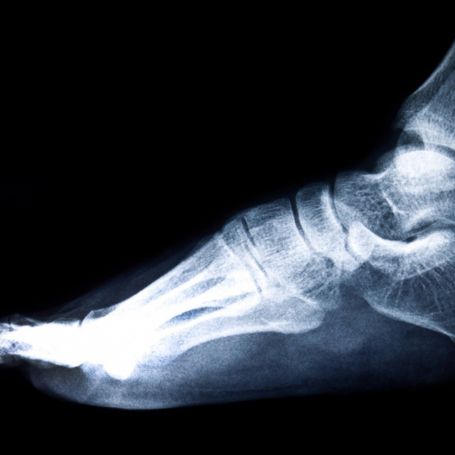 X-Ray Right Heel LAT in Karad | Heel Bone X-Ray Test Near You – Diagnopein