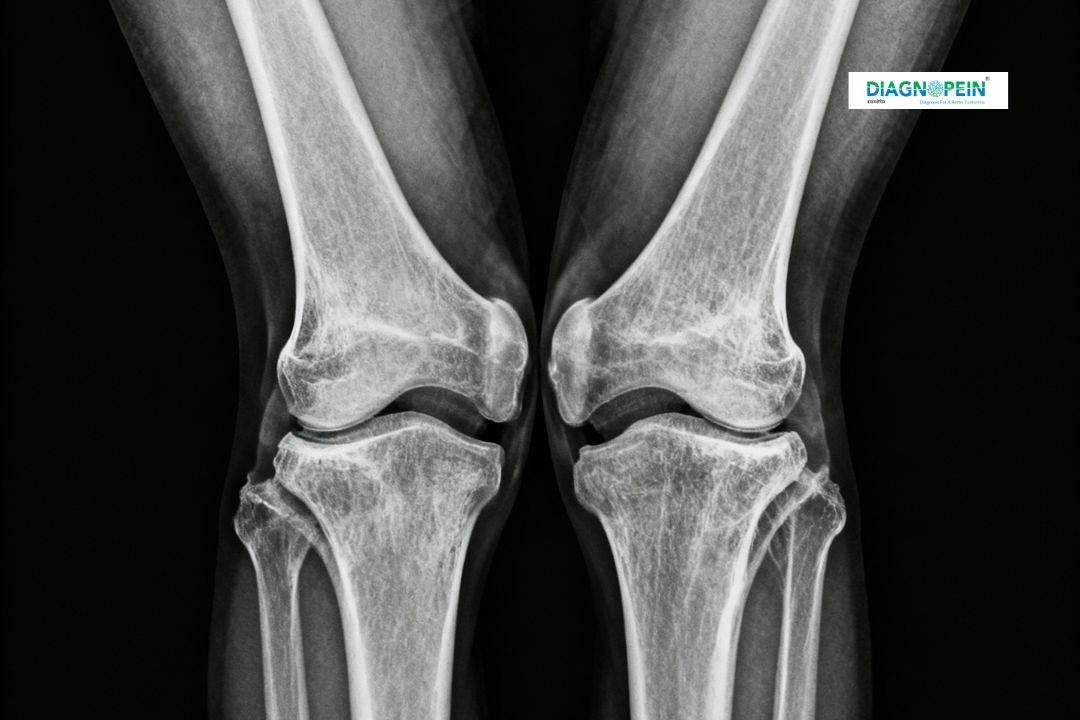 X-ray Both Knee Varus View in Karad | Digital X-ray at Diagnopein